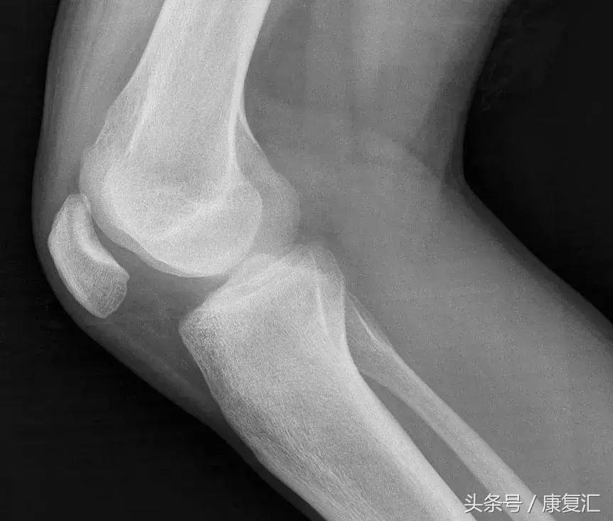 轻度慢性滑膜炎的康复锻炼,滑膜炎治疗方法和康复训练