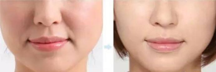 超声刀能去除法令纹吗,热玛吉祛法令纹好还是超声刀好