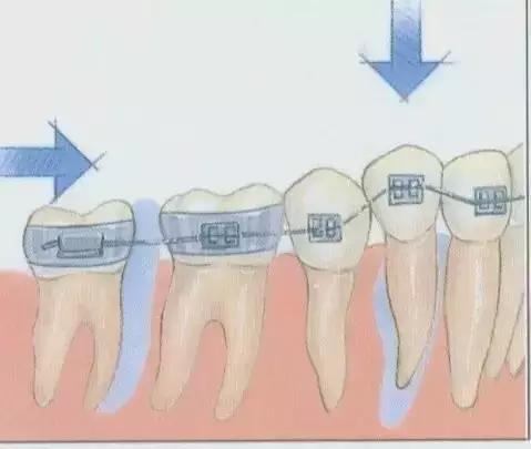 牙套上的丑钢丝,牙套上钢丝有一点锈