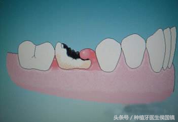 蛀牙坏了一半要根管治疗吗,蛀牙整颗烂到只剩牙根要拔吗