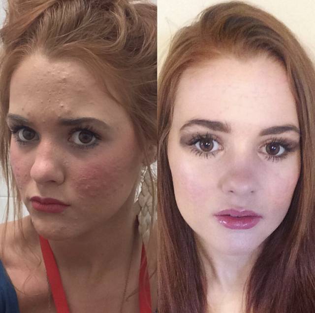 360°真实记录从满脸痘到痊愈，她红遍了Ins