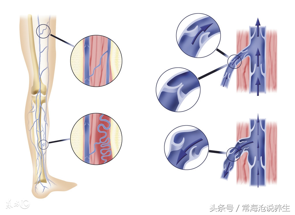 双腿静脉曲张，用中医什么样的方式解决比较好？