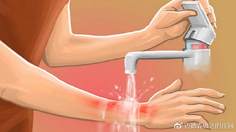 烟花轻度烧伤可以用冰敷吗,烧伤后起水泡冰敷时间过长