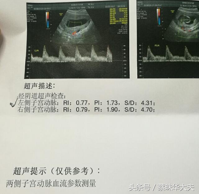 流产有必要做子宫动脉b超吗,子宫腺肌症导致反复流产怎么办