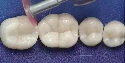 补牙怎么补性价比最高,省口腔医院补牙价格表