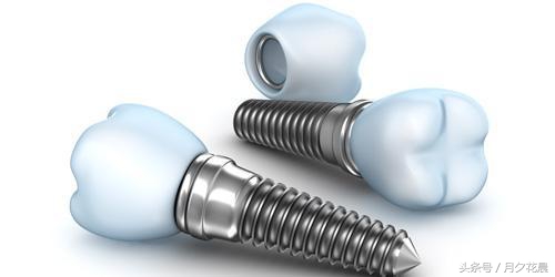 张春阳医生关于种植牙的那些事,种植牙那些事儿