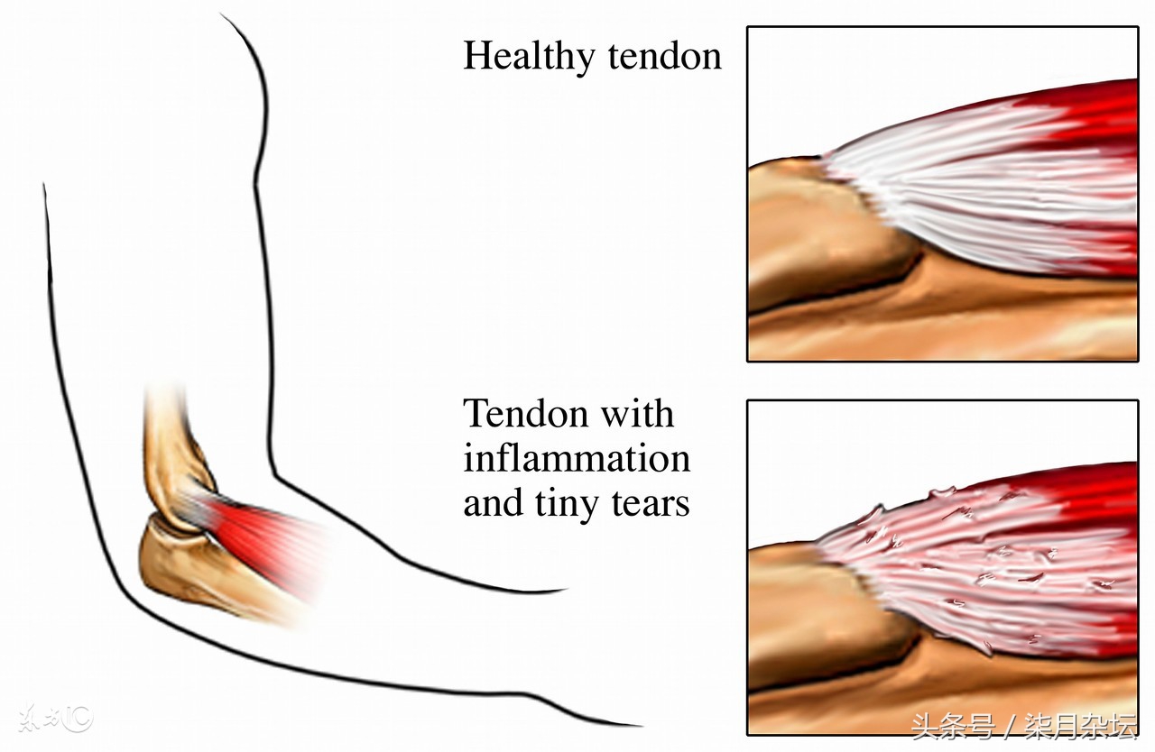 儿童如何预防网球肘,戴护肘能预防网球肘吗