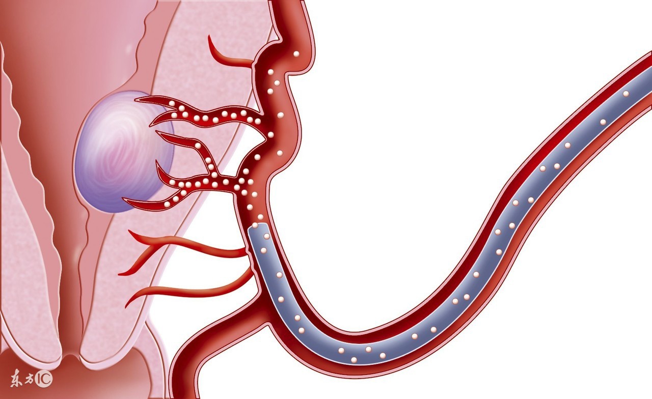 子宫肌瘤癌变的检查怎么做,子宫肌瘤会复发吗要注意什么
