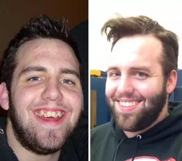 后悔整牙和不后悔整牙,整牙一般整到什么样就可以了