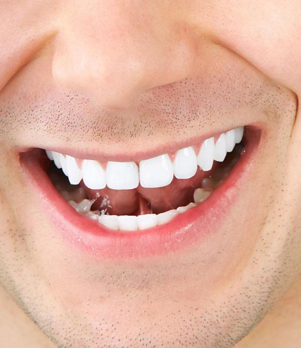 满口黄牙怎么消除,满嘴黄牙非常难看教你一招