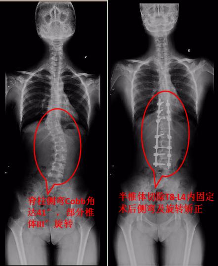 儿童先天性腰骶部脊柱侧弯,孩子弯腰驼背站不直警惕脊柱侧弯