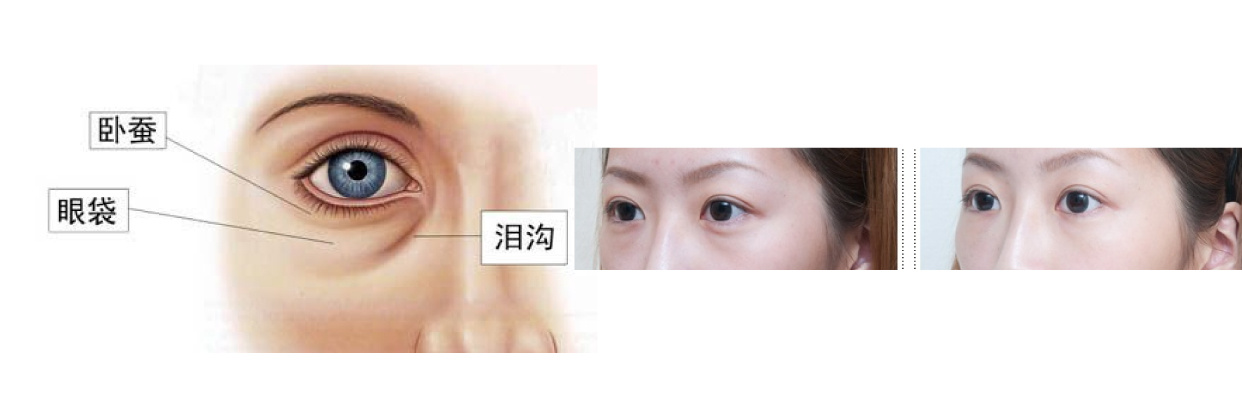 女大学生泪沟黑眼圈用什么眼霜,眼霜能去脂肪粒吗