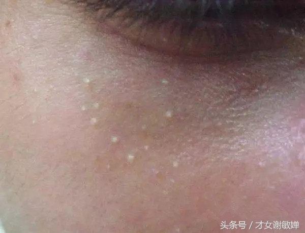 护肤处理闭合粉刺,谢敏婵的护肤品