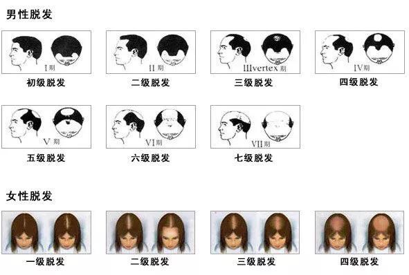 头皮脂溢性皮炎脱发,脂溢性脱发有效治疗
