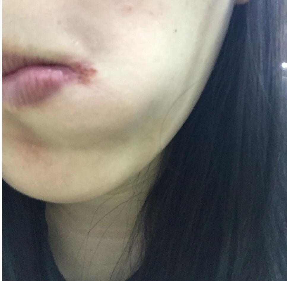 冬天上火烂嘴角怎么办？婆婆给你放大招！