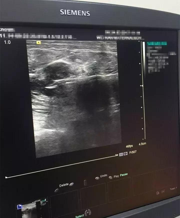 外科医生科普类视频,医院超声介入科普视频