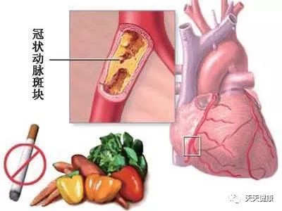 冠心病介入治疗是什么,安贞医院冠心病介入治疗新技术