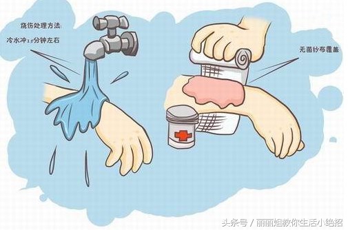 如果在家不小心被烫伤可以怎么办,不小心烫伤要怎么样才可以不烫