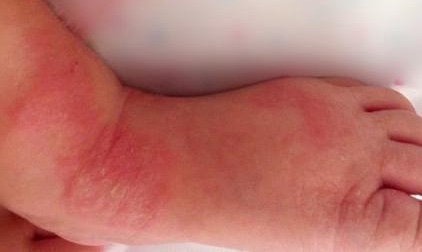 婴儿脸上疹子,婴儿疹子