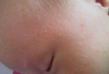 婴儿脸上疹子,婴儿疹子