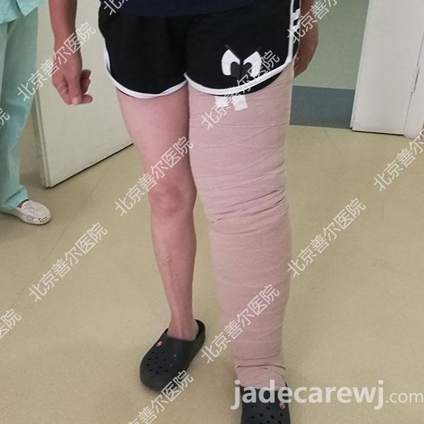 案例分享：乳腺癌术后5年、上肢淋巴水肿的治疗