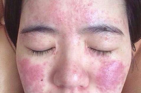 激素脸治疗恢复时间要多久？治疗激素脸的时间一般是多久？