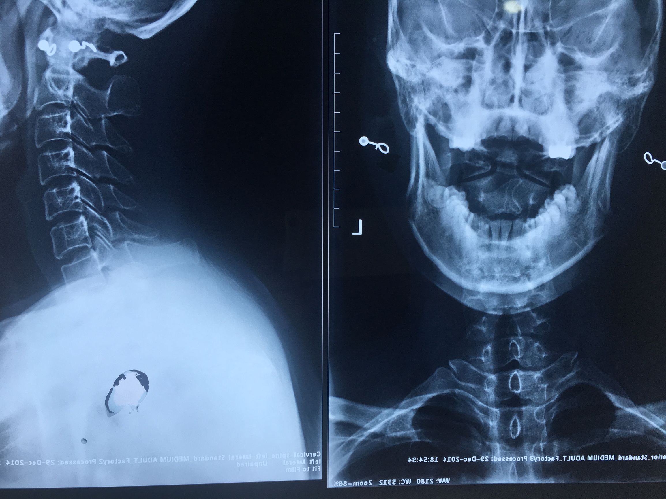 为什么脊椎病首选美式整脊治疗？