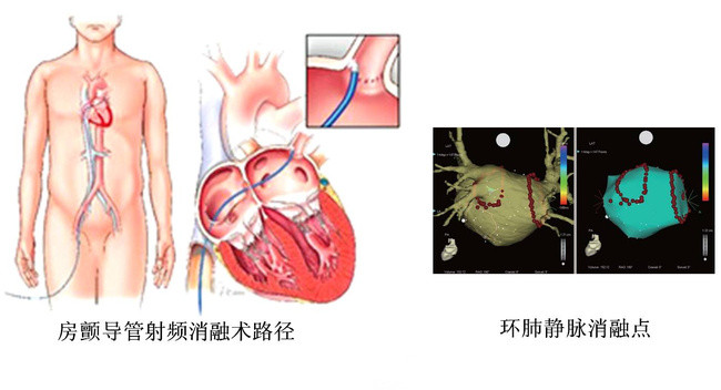 心脏房颤治疗需要多少钱,电复律治疗房颤对心脏有损害吗