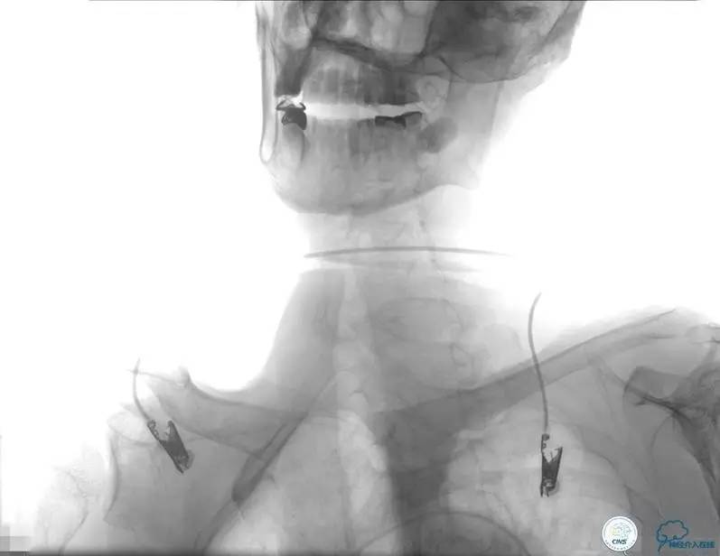 急性缺血性卒中静脉溶栓2018指南,急性缺血性卒中血管内再通标准