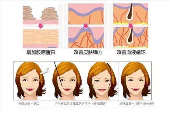 怎么去除法令纹最有效的方法医美,去皱纹最好的方法去法令纹