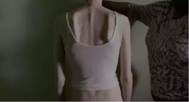 厌食症应该怎么缓解,对厌食症患者怎么心理指导