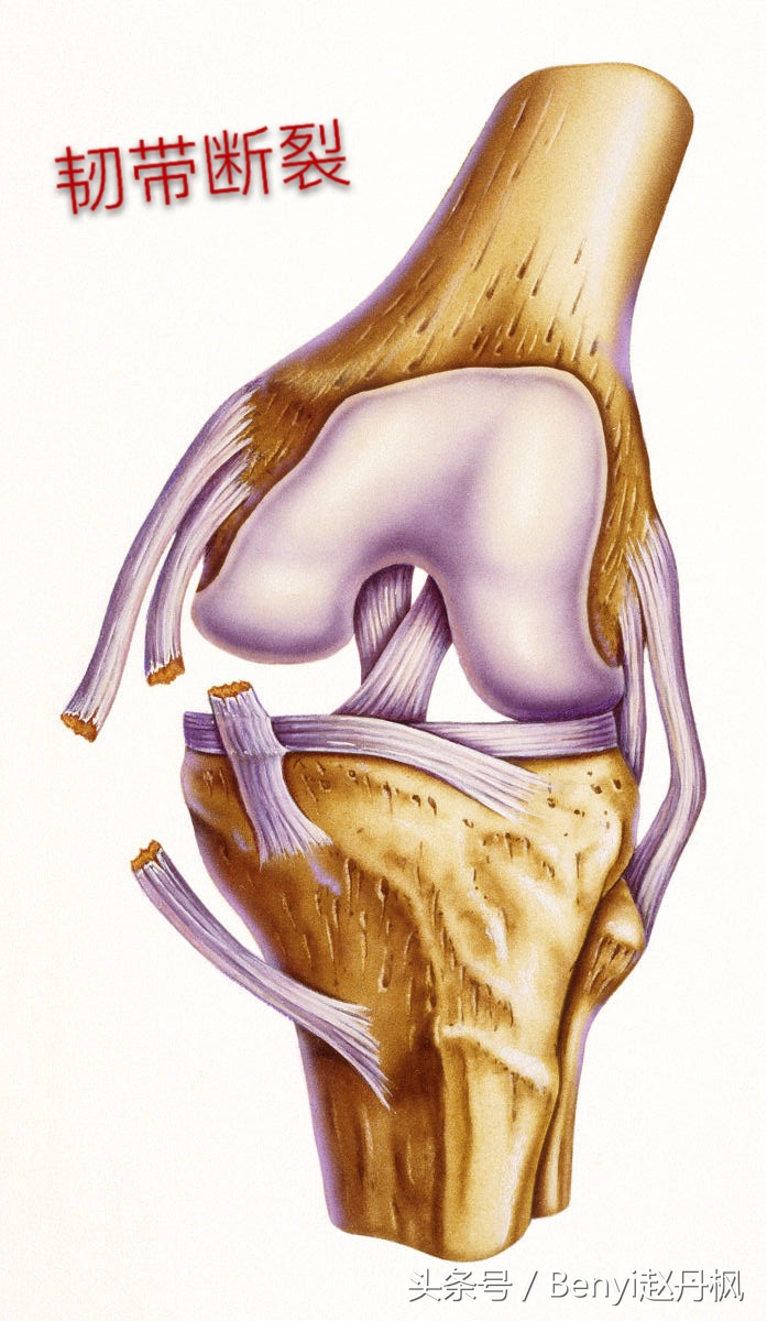 膝关节疼痛如何预防和干预,膝盖常见伤病症状
