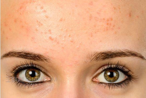 女儿额头上长痘痘怎么办,孩子额头长痘痘怎么消除