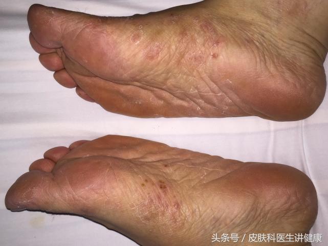 脚气引起的丹毒有什么最佳疗法,脚气感染丹毒怎么办