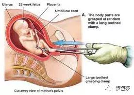 无痛人流3次会不孕吗,无痛人流花了快6千感觉被骗了