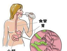 幽门螺杆菌怎么治疗可以断根中医,中医治疗幽门螺旋杆菌的中药方子