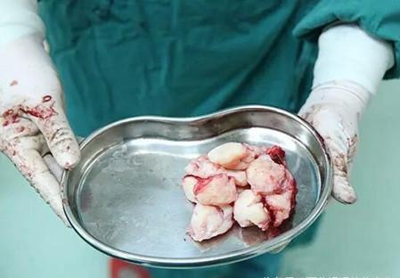 怀孕35周孕妇大哭危害,孕妇怀孕33周差点被下病危通知书