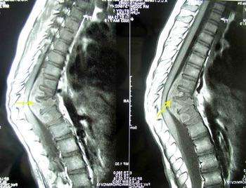 骨结核手术治疗后多长时间能痊愈,骨结核手术治疗费用