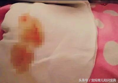 婴儿尿布上出现小血块,出生七天的宝宝尿布上有血