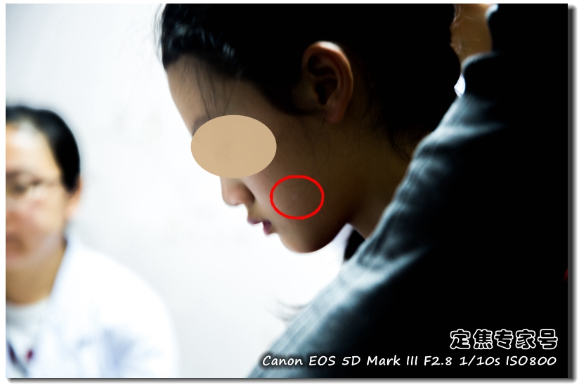 治疗头皮癣要多少钱,头皮上红斑为什么难治好