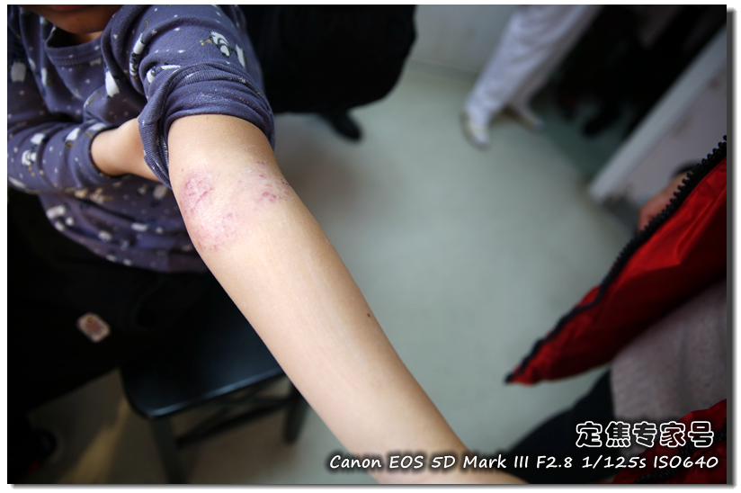 治疗头皮癣要多少钱,头皮上红斑为什么难治好