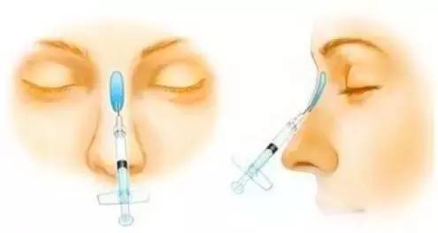 假体隆鼻都有什么术式,假体隆鼻一般用什么材料