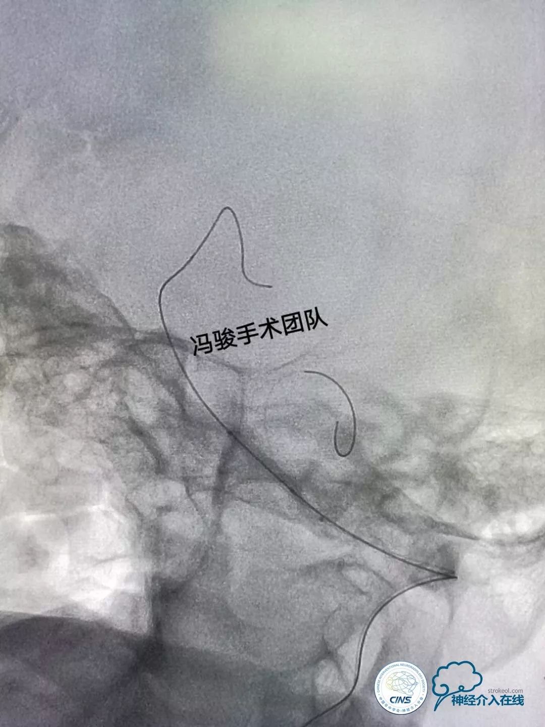 天新福—百家百言｜一例孤独椎动脉V4段并PICA重度狭窄支架手术及1年随访