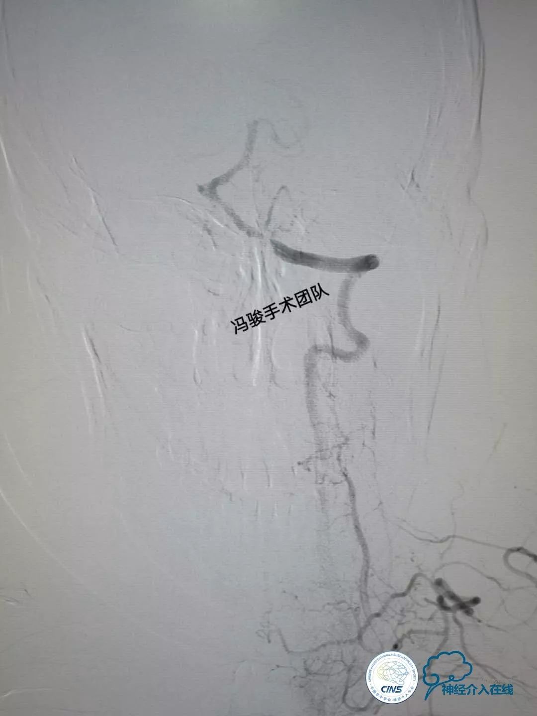 天新福—百家百言｜一例孤独椎动脉V4段并PICA重度狭窄支架手术及1年随访