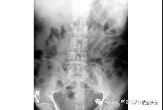 详细腹部平片解剖+正常表现+读片技巧+病例分析
