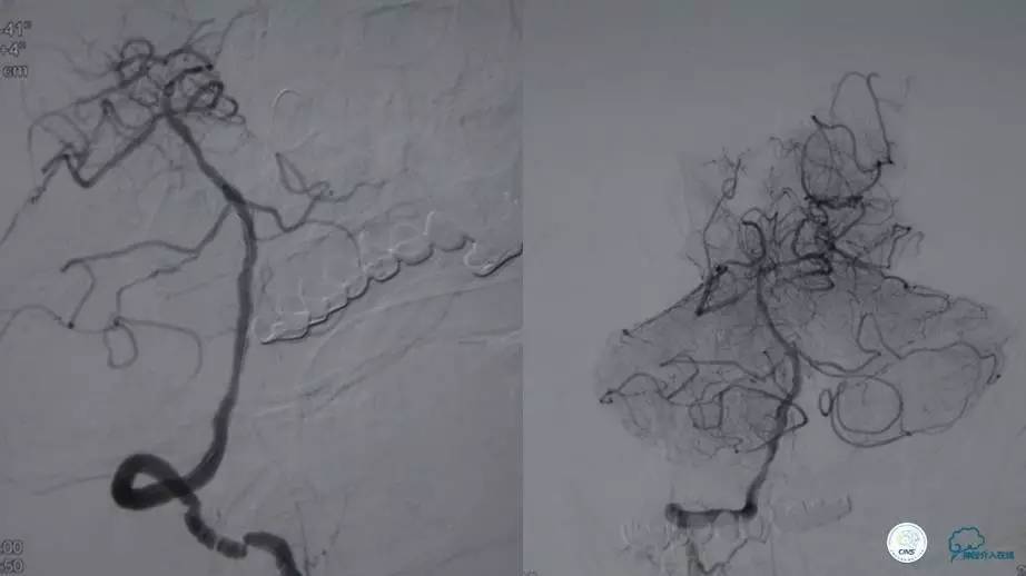 急性缺血性卒中静脉溶栓2018指南,急性缺血性卒中血管内再通标准