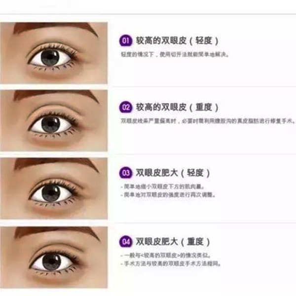 哭的时候会变双眼皮,哭多了眼睛会变双眼皮吗