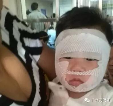 广州皮肤湿疹专家,湿疹皮肤干燥瘙痒挠出血