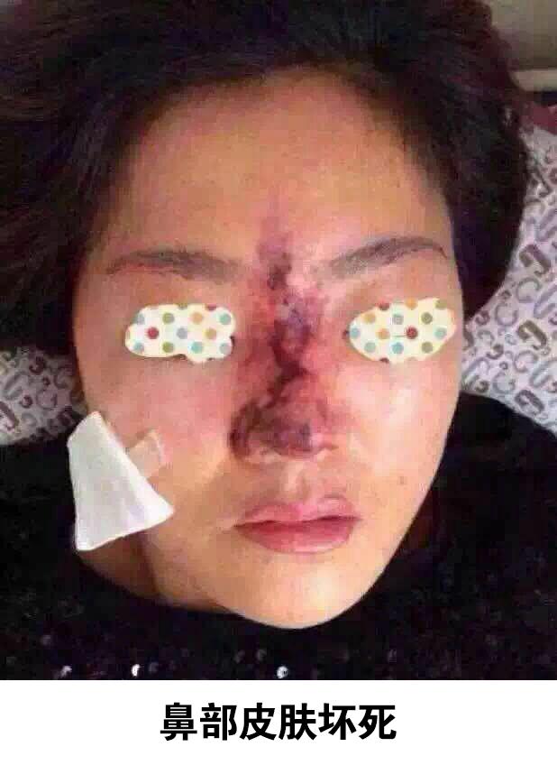 注射隆鼻的危险,注射隆鼻眼瞎