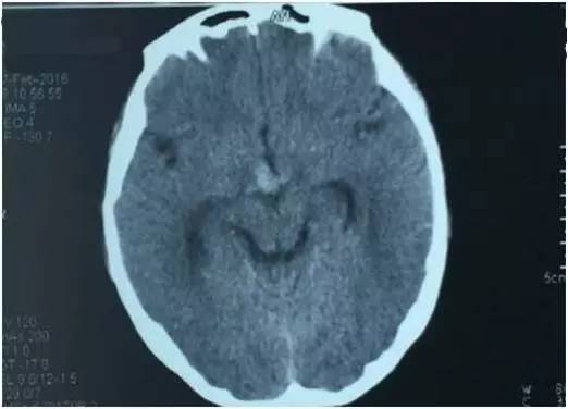 基底动脉顶端动脉瘤加左侧小脑上动脉瘤以Y型支架结合弹簧圈栓塞